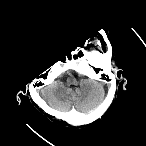 File:Cerebral contusions, subarachnoid hemorrhage and subdural hygromas (Radiopaedia 55399-61829 Axial non-contrast 26).png