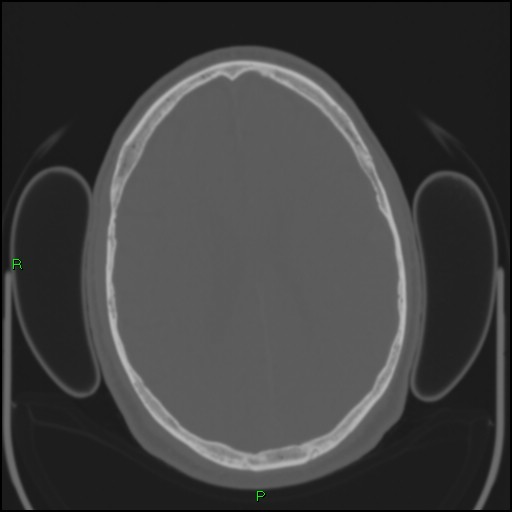 Cerebral contusions (Radiopaedia 33868-35039 Axial bone window 138).jpg