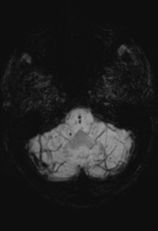 File:Cerebral hemorrhagic contusions- temporal evolution (Radiopaedia 40224-42757 Axial SWI 6).png