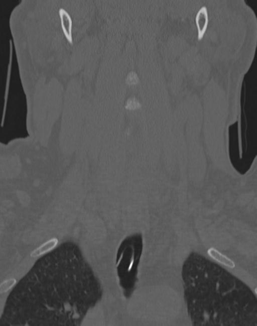 Cerebral hemorrhagic contusions and cervical spine fractures (Radiopaedia 32865-33841 Coronal bone window 18).jpg