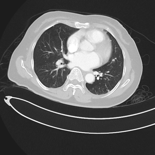Cerebral metastases (Radiopaedia 33041-34055 Axial lung window 31).png