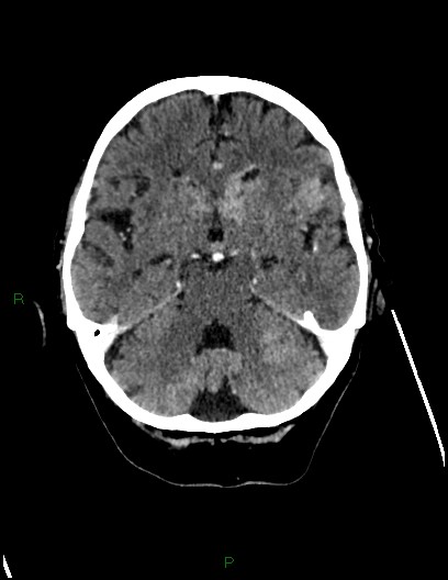 File:Cerebral metastases - ependymal and parenchymal (Radiopaedia 79877-93131 Axial C+ delayed 28).jpg
