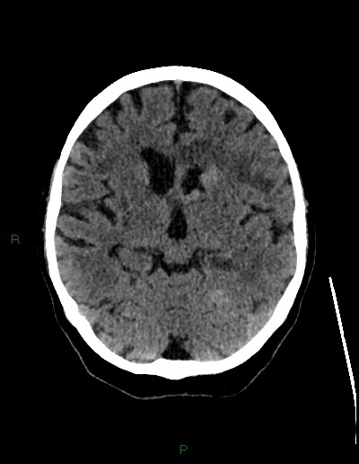 File:Cerebral metastases - ependymal and parenchymal (Radiopaedia 79877-93131 Axial non-contrast 34).jpg