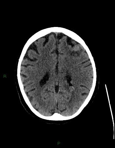 File:Cerebral metastases - ependymal and parenchymal (Radiopaedia 79877-93131 Axial non-contrast 51).jpg