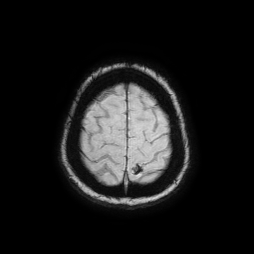 Cerebral metastases - melanoma (Radiopaedia 80972-94522 Axial SWI 87).jpg