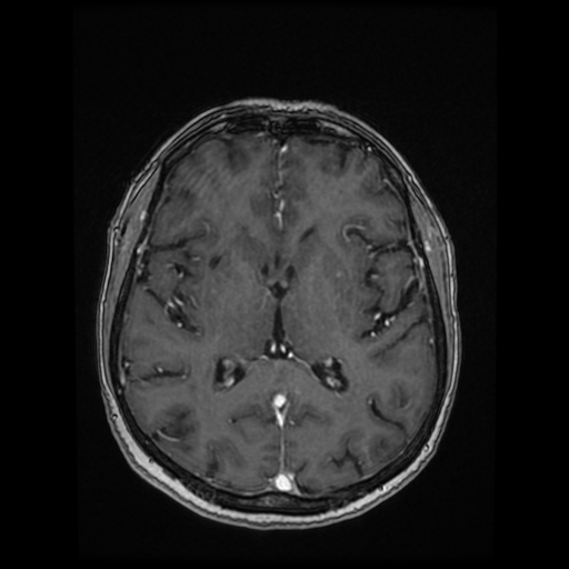 Cerebral metastases - melanoma (Radiopaedia 80972-94522 Axial T1 C+ 56).jpg