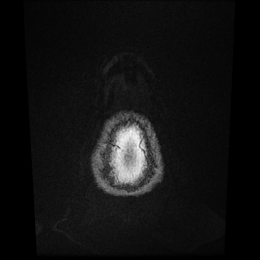 Cerebral metastases - melanoma (Radiopaedia 80972-94522 Axial T1 C+ 92).jpg