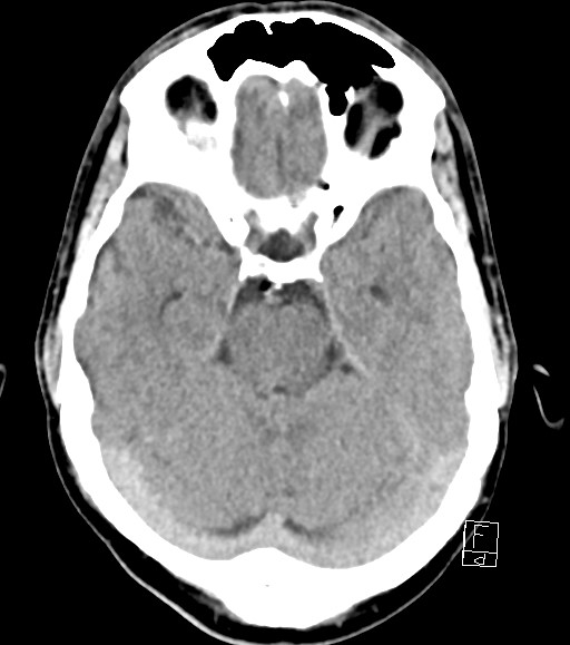 Cerebral metastases - testicular choriocarcinoma (Radiopaedia 84486-99855 Axial non-contrast 37).jpg