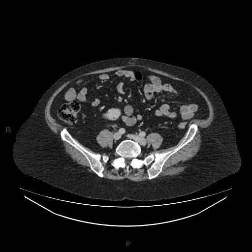 Cerebral metastasis from renal cell carcinoma (Radiopaedia 82306-96378 A 124).jpg