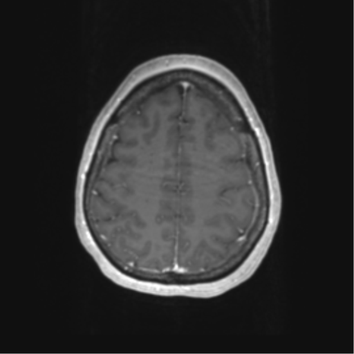 Cerebral metastasis mimicking glioblastoma (Radiopaedia 69155-78937 Axial T1 C+ 54).png