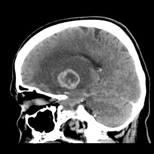 Cerebral metastasis to basal ganglia (Radiopaedia 81568-95412 Sagittal C+ delayed 24).png
