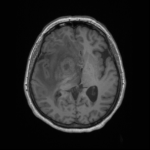 Cerebral metastasis to basal ganglia (Radiopaedia 81568-95413 Axial T1 35).png