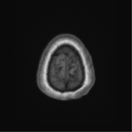 File:Cerebral metastasis to basal ganglia (Radiopaedia 81568-95413 Axial T1 71).png