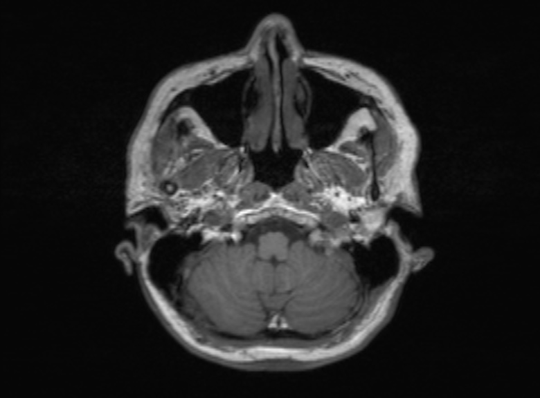 Cerebral ring enhancing lesions - cerebral metastases (Radiopaedia 44922-48817 Axial T1 334).jpg