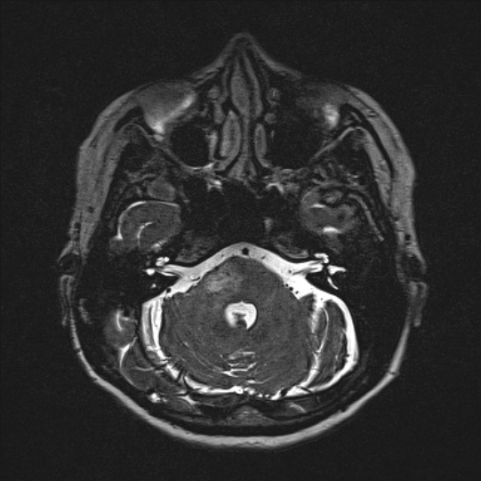 Cerebral ring enhancing lesions - cerebral metastases (Radiopaedia 44922-48817 F 35).jpg