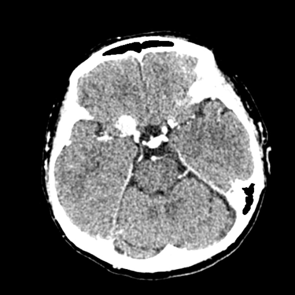 Cerebral ring enhancing lesions - cerebral metastases (Radiopaedia 44922-48818 B 102).jpg