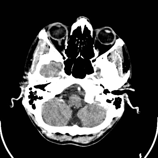 File:Cerebral toxoplasmosis (Radiopaedia 43956-47460 Axial C+ delayed 2).jpg