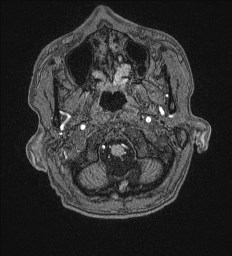 File:Cerebral toxoplasmosis (Radiopaedia 43956-47461 Axial T1 2).jpg
