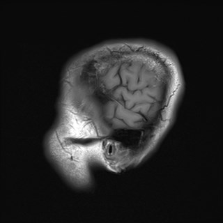 File:Cerebral toxoplasmosis (Radiopaedia 43956-47461 Sagittal T1 20).jpg