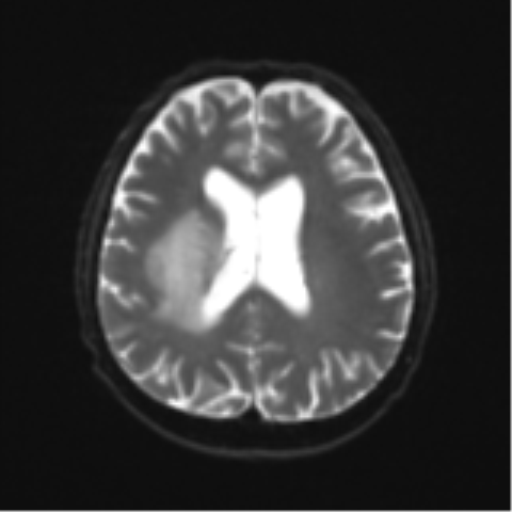 File:Cerebral toxoplasmosis (Radiopaedia 54575-60804 Axial DWI 21).png