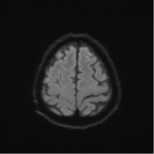 Cerebral toxoplasmosis (Radiopaedia 54575-60804 Axial DWI 59).png