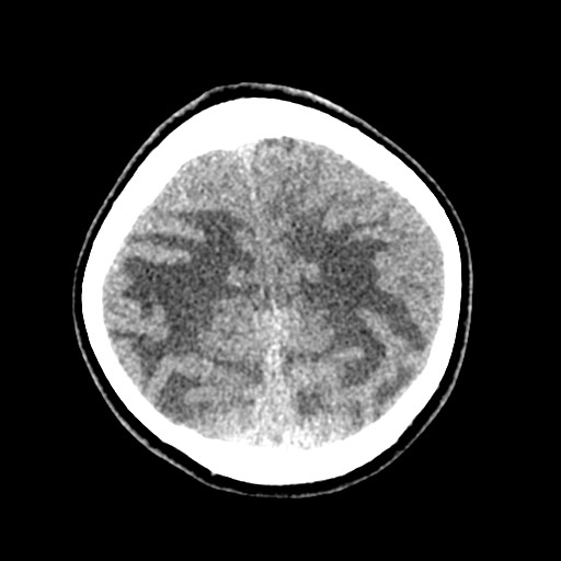 Cerebral tuberculosis with dural sinus invasion (Radiopaedia 60353-68018 Axial non-contrast 50).jpg