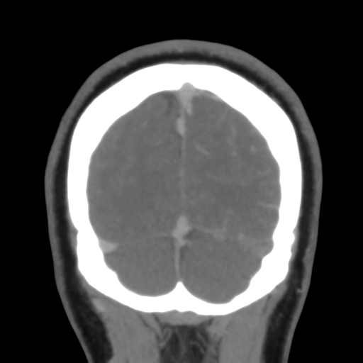 File:Cerebral venous infarction due to transverse sinus thrombosis (Radiopaedia 34688-36120 Coronal 52).png
