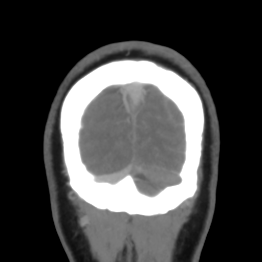 Cerebral venous infarction due to transverse sinus thrombosis (Radiopaedia 34688-36120 Coronal 55).png