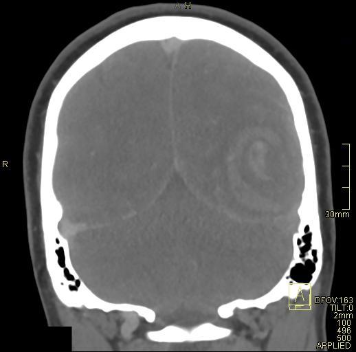 Cerebral venous sinus thrombosis (Radiopaedia 91329-108965 Coronal venogram 67).jpg