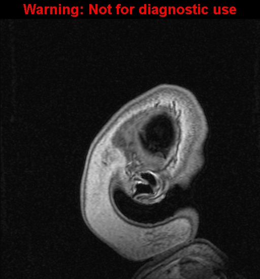 File:Cerebral venous thrombosis (Radiopaedia 37224-39208 Sagittal T1 C+ 149).jpg
