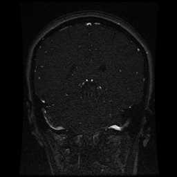 Cerebral venous thrombosis - ulcerative colitis (Radiopaedia 66049-75219 Coronal MRV 46).jpg