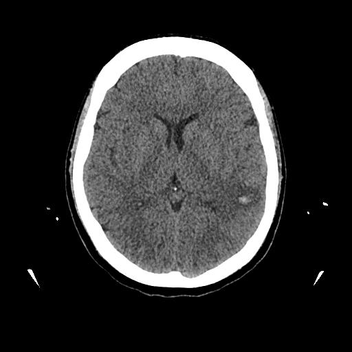 Cerebral venous thrombosis with venous hemorrhagic infarct (Radiopaedia 90354-107660 Axial non-contrast 27).jpg