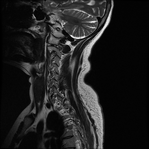 File:Cerebrospinal tuberculosis (Radiopaedia 68573-78180 Sagittal T2 3).jpg