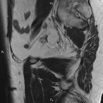 File:Cervical adenocarcinoma (Radiopaedia 65011-73985 Sagittal T2 26).jpg