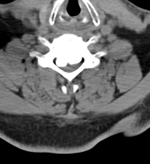 File:Cervical canal stenosis - OPLL and osteophytes (Radiopaedia 47329-51910 Axial non-contrast 40).png