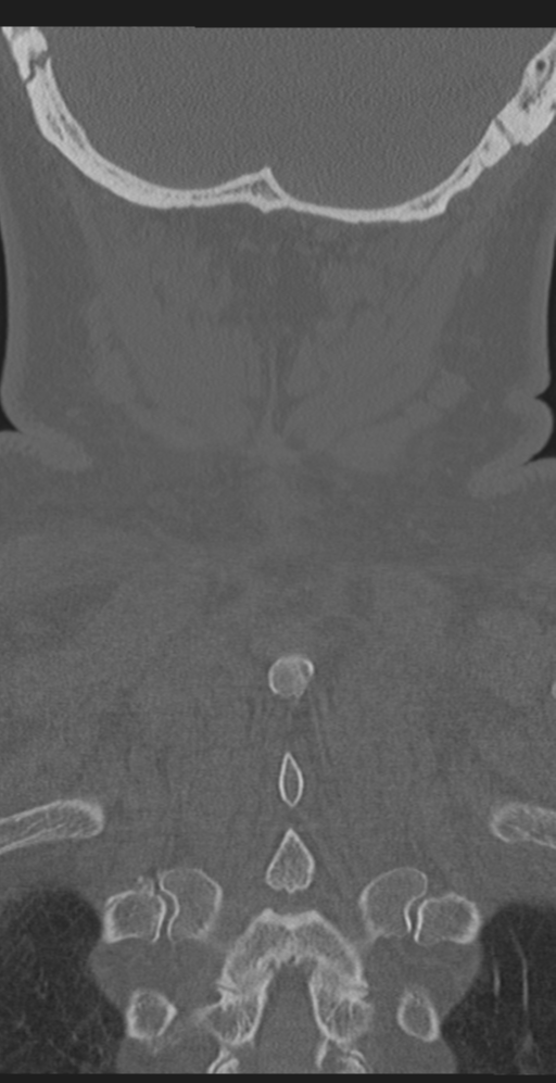 Cervical canal stenosis due to ossification of the posterior longitudinal ligament (Radiopaedia 47260-51823 Coronal bone window 59).png