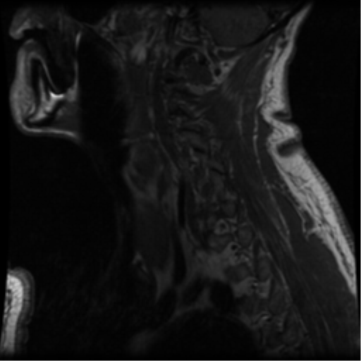 File:Cervical canal stenosis with cord compression (Radiopaedia 34114-35374 Sagittal T1 1).png