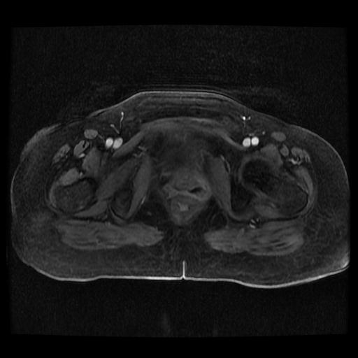 Cervical carcinoma (Radiopaedia 70924-81132 Axial T1 C+ fat sat 120).jpg