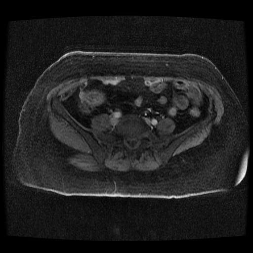 Cervical carcinoma (Radiopaedia 70924-81132 Axial T1 C+ fat sat 80).jpg