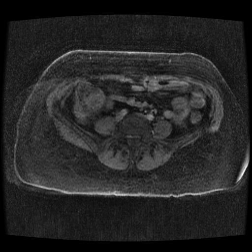 File:Cervical carcinoma (Radiopaedia 70924-81132 Axial T1 C+ fat sat 86).jpg