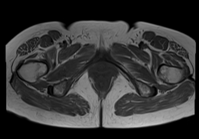 File:Cervical carcinoma (Radiopaedia 88312-104943 Axial T1 20).jpg