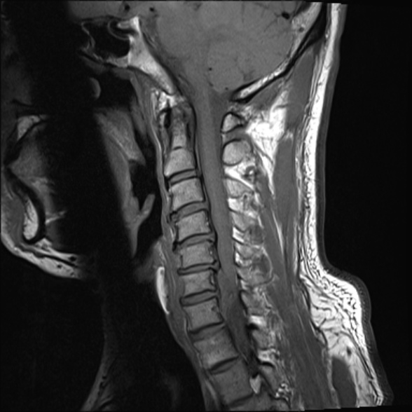 File:Cervical disc extrusion (Radiopaedia 53950-60077 Sagittal T1 9).jpg