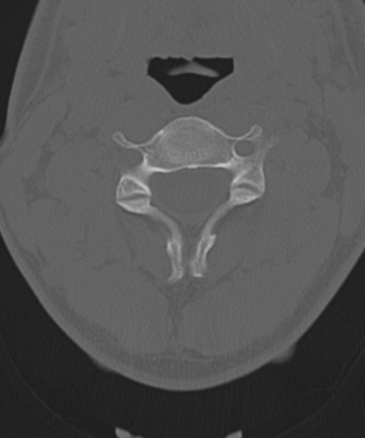 Cervical intercalary bone (Radiopaedia 35211-36748 Axial bone window 24).png