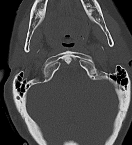 Cervical spine ACDF loosening (Radiopaedia 48998-54070 Axial bone window 11).png