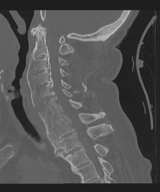 Cervical spine fracture in the setting of ankylosis (Radiopaedia 37038-38715 Sagittal bone window 40).png