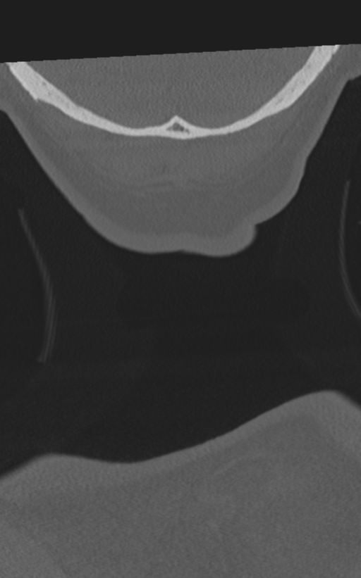 Cervical spine fractures with vertebral artery dissection (Radiopaedia 53296-59268 Coronal bone window 83).png