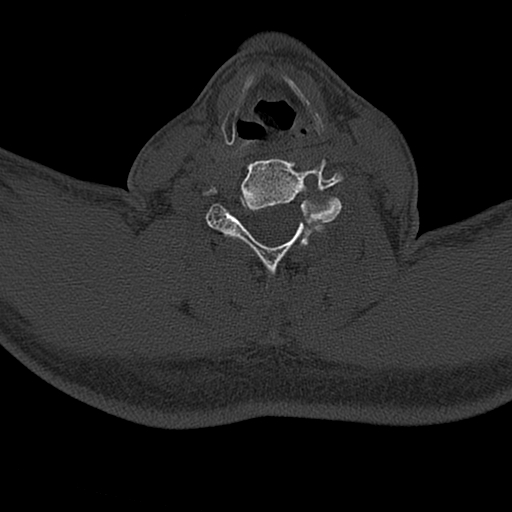 Cervical spine trauma with tear drop fracture and perched facet joint (Radiopaedia 53989-60127 Axial bone window 114).jpg