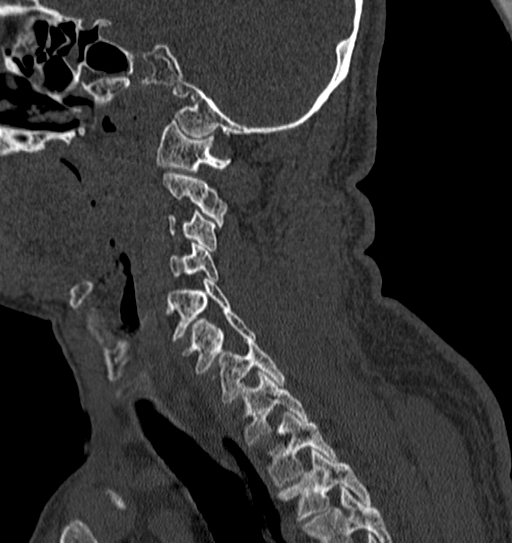 Cervical spine trauma with tear drop fracture and perched facet joint (Radiopaedia 53989-60127 Sagittal bone window 46).jpg