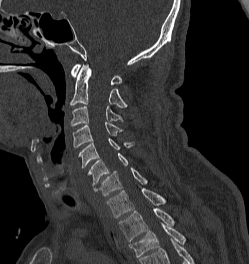 File:Cervical spine trauma with tear drop fracture and perched facet joint (Radiopaedia 53989-60127 Sagittal bone window 90).jpg