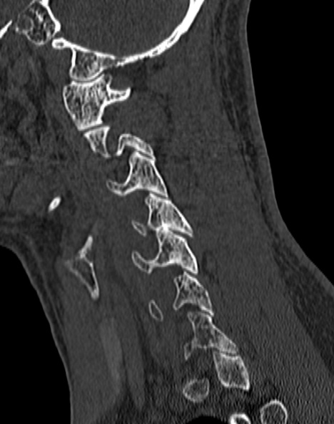 Cervical spondylodiscitis (Radiopaedia 28057-29489 Sagittal bone window 45).jpg